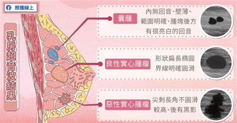 乳房有毛|乳頭長毛是多毛症還是腫瘤？醫師告訴你如何從併發症判斷｜每日